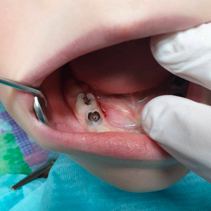 Зубы разрушены кариесом