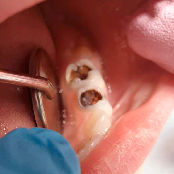 Ещё два молочных зуба значительно разрушены кариесом