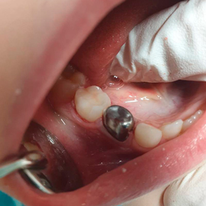 Установлена металлическая коронка на молочный зуб