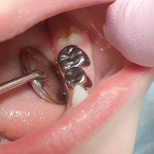 Оба зуба восстановлены металлическими коронками